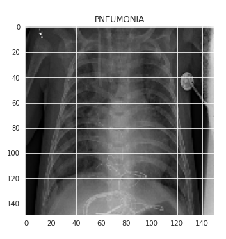 An grided X-ray image of Pneumonia shows two axis.  The horizontal axis ranges from 0 to 140, and the vertical axis ranges from 140 to 0.